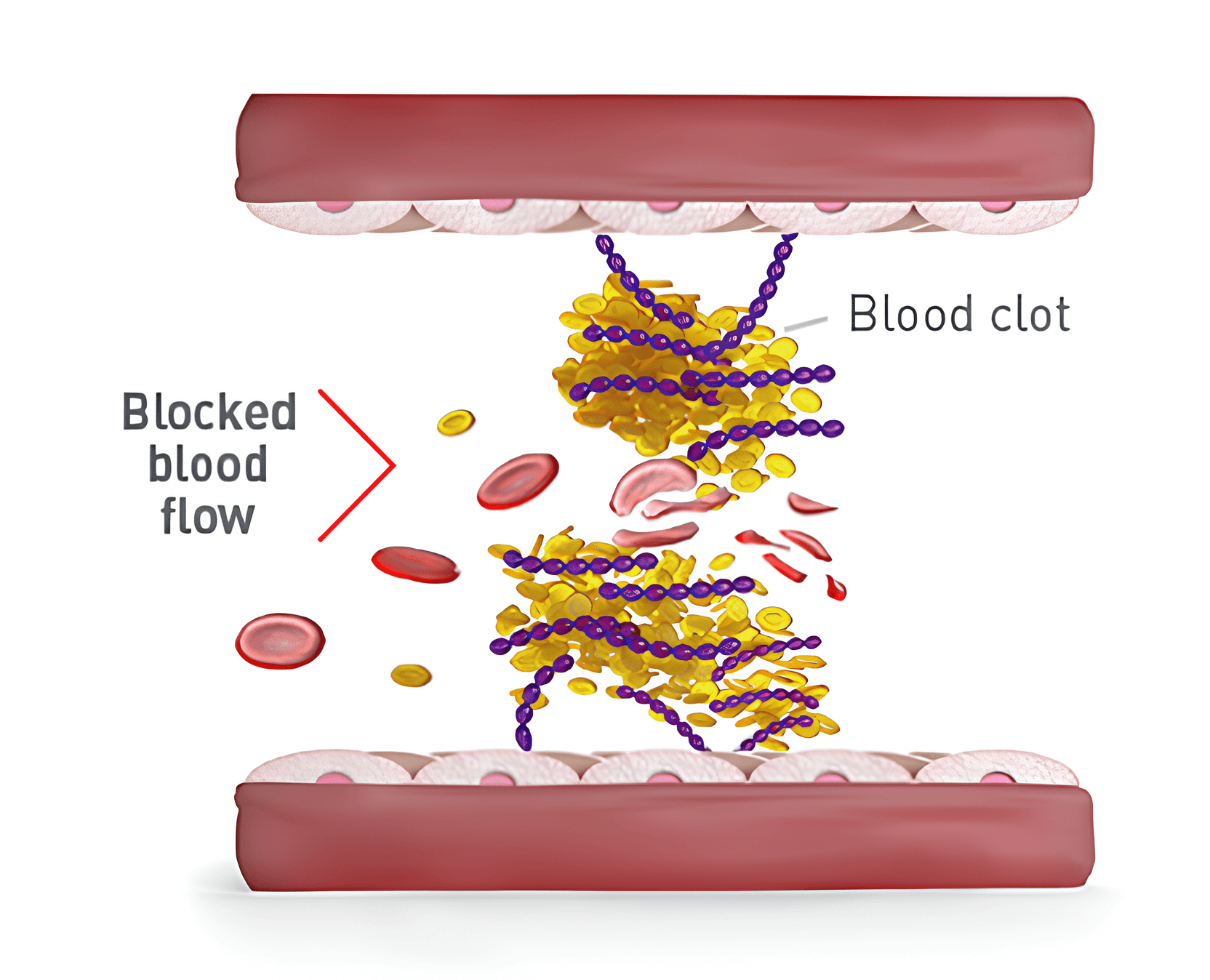 Blocked blood flow with platelets stuck to large vWF stopping red blood cells from passing through
